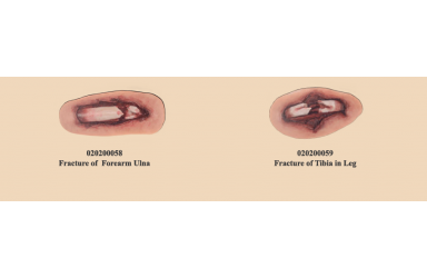 [PM-007] 개방성 골절